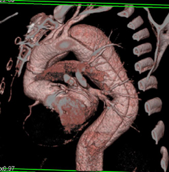 Type B Dissection With Prior Type A Repair - CTisus CT Scan