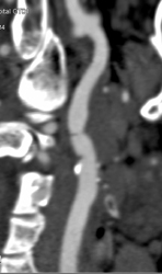 Carotid Stenosis - CTisus CT Scan