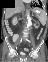 Renal Artery Aneurysm - CTisus CT Scan