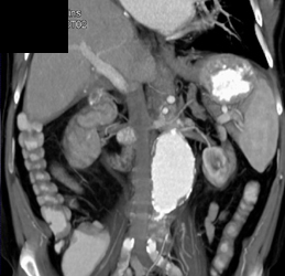 Renal Artery Aneurysm - CTisus CT Scan