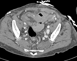 Av Shunt in Thigh - CTisus CT Scan