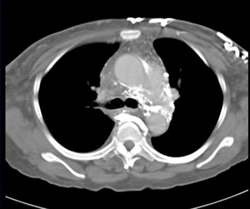 SVC Occlusion With Collaterals - CTisus CT Scan