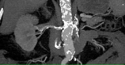 Atherosclerotic Cardiovascular Disease of Aortic and Renal Arteries - CTisus CT Scan