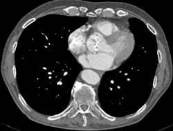 Infrarenal Aortic Aneurysm - CTisus CT Scan