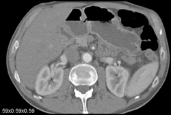 Vasculitis of the SMA With Wall Thickening - CTisus CT Scan