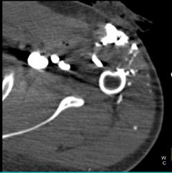 Stab Wound of the Shoulder - CTisus CT Scan