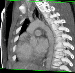 Supra-vavular Stenosis- Williams Syndrome - CTisus CT Scan