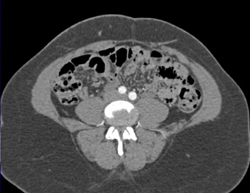 Inferior Epigastric Artery Enters the Rectus Muscle-planning for DIEP Flap - CTisus CT Scan