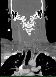 GSW Chest Wall - CTisus CT Scan