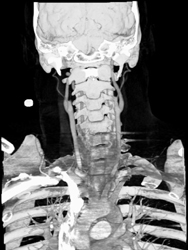 Patent Carotid Arteries - CTisus CT Scan