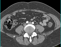 Planning A DIEP Surgery - CTisus CT Scan