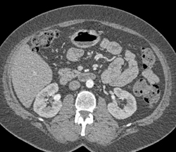 Bilateral Renal Artery Aneurysms and Splenic Artery Aneurysms - CTisus CT Scan