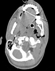 GSW of Neck Without Extravasation - CTisus CT Scan