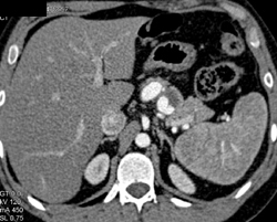 Splenic Artery Aneurysm - CTisus CT Scan