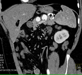 Splenic Artery Aneurysm - CTisus CT Scan