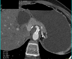 Stent in Celiac Artery - CTisus CT Scan