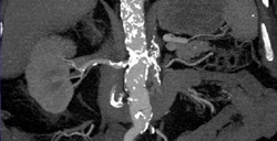 Occluded Left Renal Artery - CTisus CT Scan