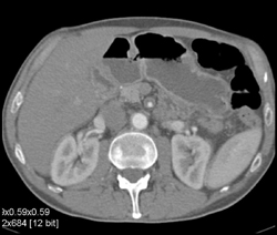 SMA Vasculitis - CTisus CT Scan