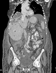 Stent in IVC With Subcutaneous Collaterals - CTisus CT Scan