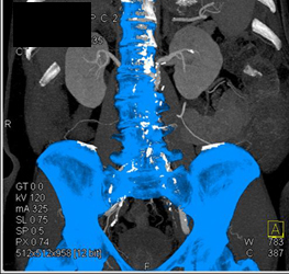 Iliac Artery Aneurysm - CTisus CT Scan