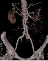 Iliac Artery Aneurysm - CTisus CT Scan