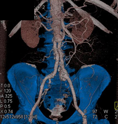 Iliac Artery Aneurysm - CTisus CT Scan