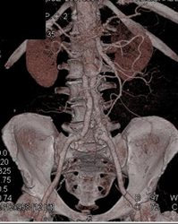 Aortic Bypass Graft - CTisus CT Scan