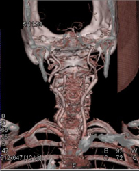 Right Internal Carotid Artery Stenosis - CTisus CT Scan