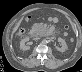 Stent in the Left Renal Artery - CTisus CT Scan