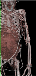 Axillary Artery Aneurysms - CTisus CT Scan