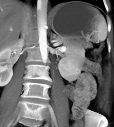 Av Fistulae - CTisus CT Scan