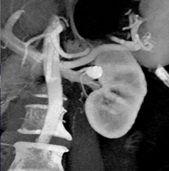 Diseased Superficial Femoral Arteries (SFAs) - CTisus CT Scan