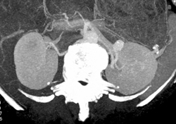 Diseased Superficial Femoral Arteries (SFAs) - CTisus CT Scan