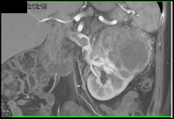 Normal Axillary Artery - CTisus CT Scan