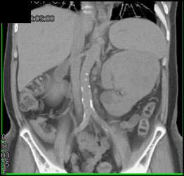 Renal Artery Stenosis-r > L - CTisus CT Scan