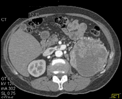 Ischemic Bowel - CTisus CT Scan