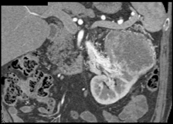 Splenic and Liver Infarct S/P Liver Trauma - CTisus CT Scan