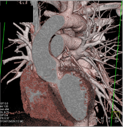 Narrowed Superficial Femoral Artery (SFA) - CTisus CT Scan