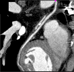 Aortic Dissection - CTisus CT Scan