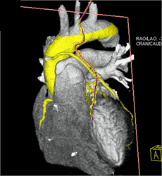 Type A Dissection With 10 Cm Root - CTisus CT Scan