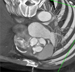 Fibromuscular Dysplasia (FMD) of Right Kidney - CTisus CT Scan