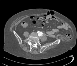 Renal Tubular Acidosis - CTisus CT Scan