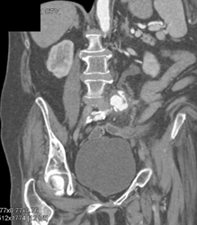 Fibromuscular Dysplasia (FMD) -right - CTisus CT Scan