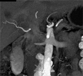 Splenic Artery Aneurysm-2 Degrees?? Pancreatitis - CTisus CT Scan