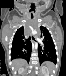 Superior Mesenteric Artery (SMA) Stenosis - CTisus CT Scan