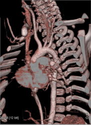 Superior Mesenteric Artery (SMA) Stenosis - CTisus CT Scan