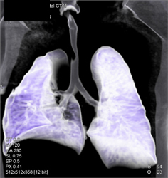 Superior Mesenteric Artery (SMA) Stenosis - CTisus CT Scan