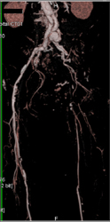 Takayasu's Arteritis - CTisus CT Scan