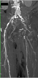 Stent in Right Superficial Femoral Artery (SFA) - CTisus CT Scan