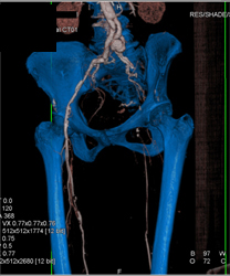 Stent for Aneurysm Repair - CTisus CT Scan